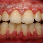 Doena periodontal ligada ao aumento do risco de doena renal crnica
