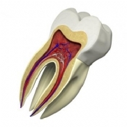 Material biocompatvel durvel potencialmente reduz a sensibilidade dentria