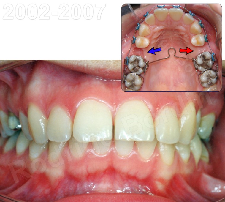 Featured image of post Dente Encavalado Com Aparelho Dente encavalado quais os poss veis tratamentos
