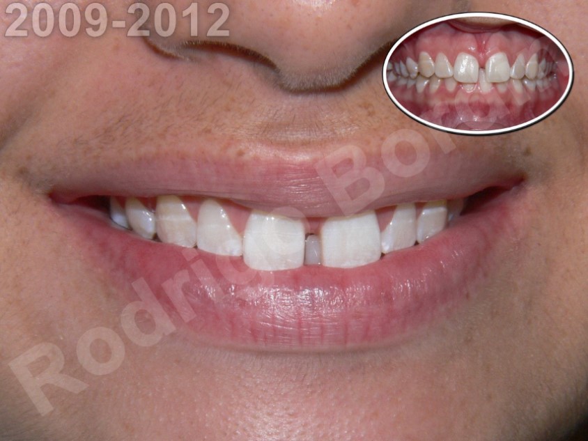 Antes
