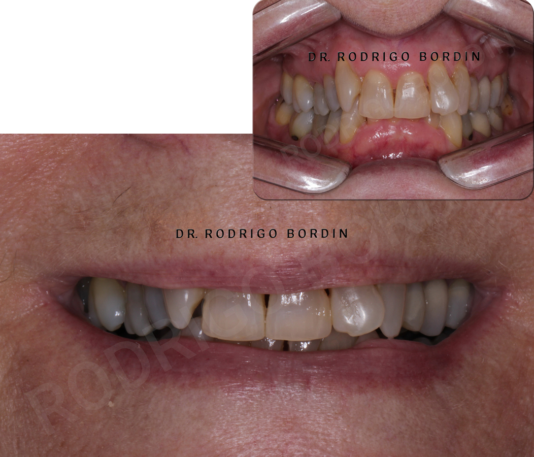 Invisalign preço: confira mais sobre o que é e qual o preço!