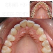 Quanto tempo dura uma restauração (obturação) branquinha nos dentes?